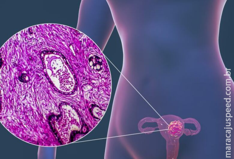 Projeto prevê exame genético para o diagnóstico de HPV pelo SUS Projeto prevê exame genético para o diagnóstico de HPV pelo SUS
