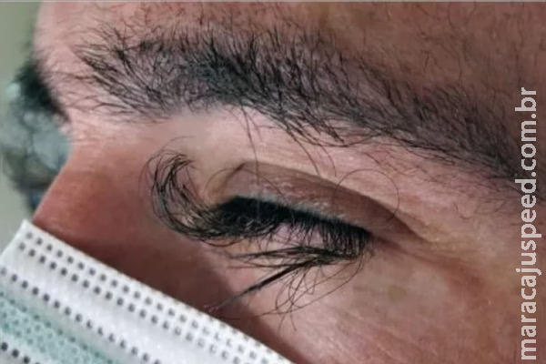 Cílios de homem crescem quase 2 cm durante tratamento contra câncer