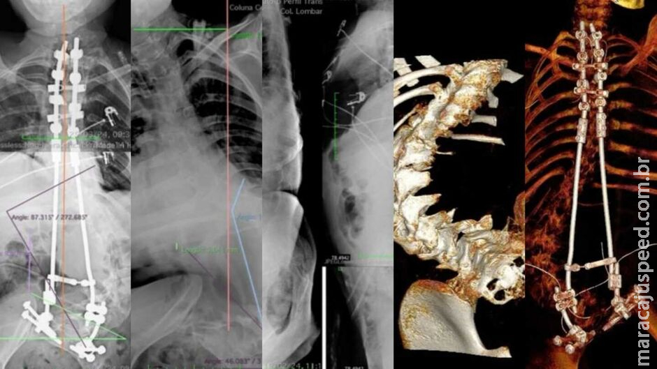 Com técnica francesa, neurocirurgião reverte escoliose de paciente de 15 anos em Campo Grande