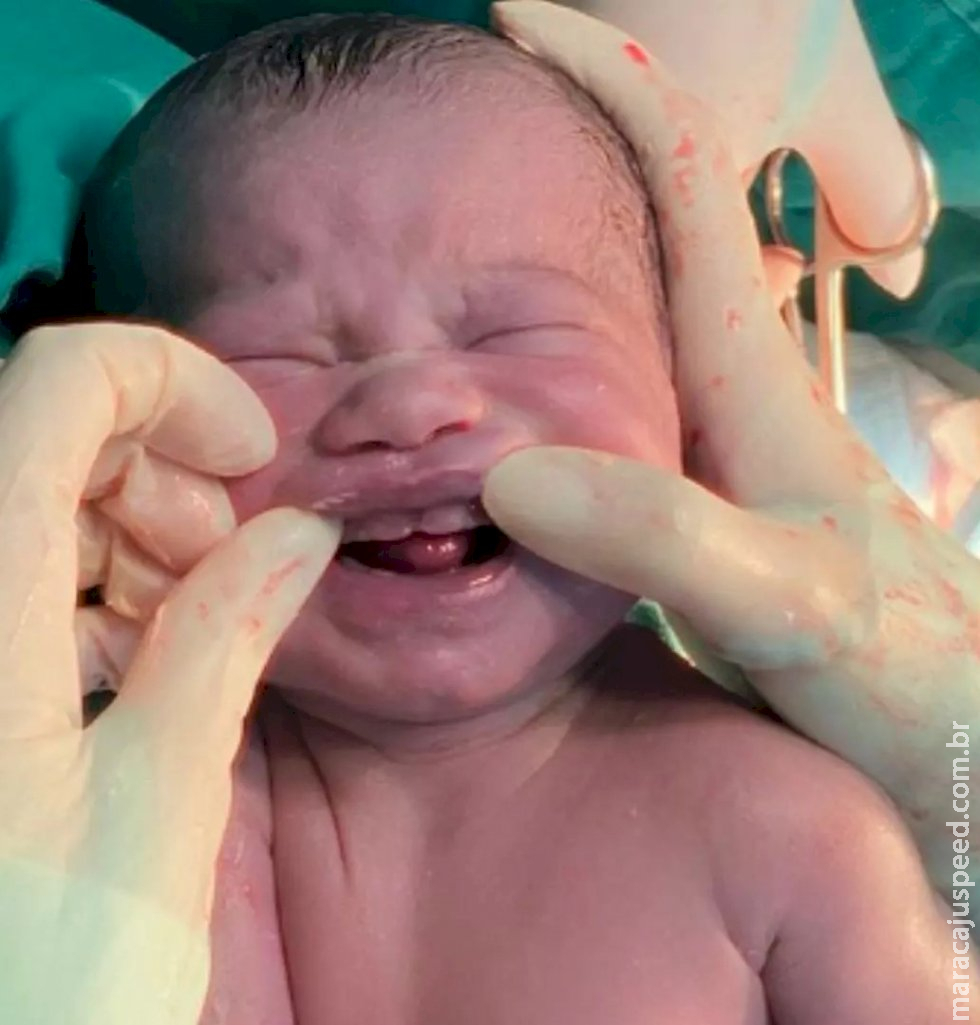 Bebê surpreende pais e equipe médica ao nascer com seis dentes em maternidade de Campo Grande Bebê surpreende pais e equipe médica ao nascer com seis dentes em maternidade de Campo Grande