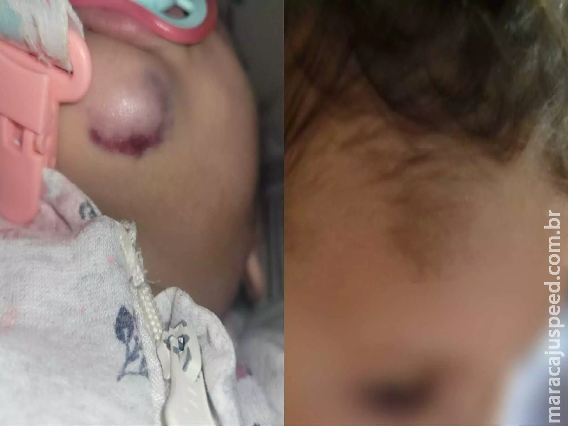 Bebê autista sofre hematomas e mãe reclama da falta de assistente em EMEI de Campo Grande