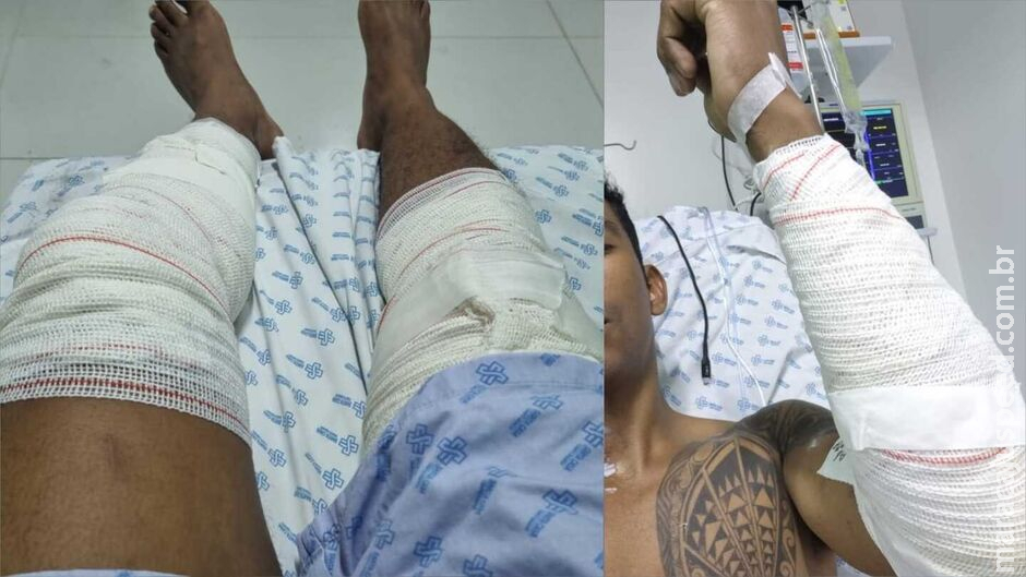 Bombeiro ferido em incêndio no Cerejeiras teve queimaduras de 1°, 2° e 3° grau Bombeiro ferido em incêndio no Cerejeiras teve queimaduras de 1°, 2° e 3° grau