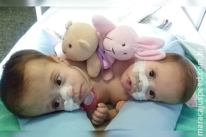 Caso raro: gêmeas siamesas com três pernas deixam hospital pela 1ª vez Caso raro: gêmeas siamesas com três pernas deixam hospital pela 1ª vez