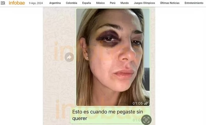 Ex-primeira-dama da Argentina mostra hematomas após agressões Ex-primeira-dama da Argentina mostra hematomas após agressões