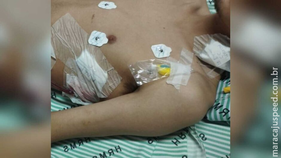 Jovem perde pulmão por fumar narguilé e Jovem perde pulmão por fumar narguilé e
