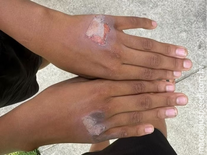 Mãe queima filho com chapinha de cabelo: Mãe queima filho com chapinha de cabelo: