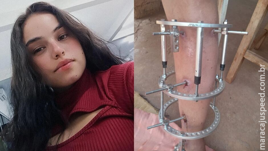 Com pino na perna, jovem sofre sem atendimento por ter iniciado tratamento médico fora de MS Com pino na perna, jovem sofre sem atendimento por ter iniciado tratamento médico fora de MS