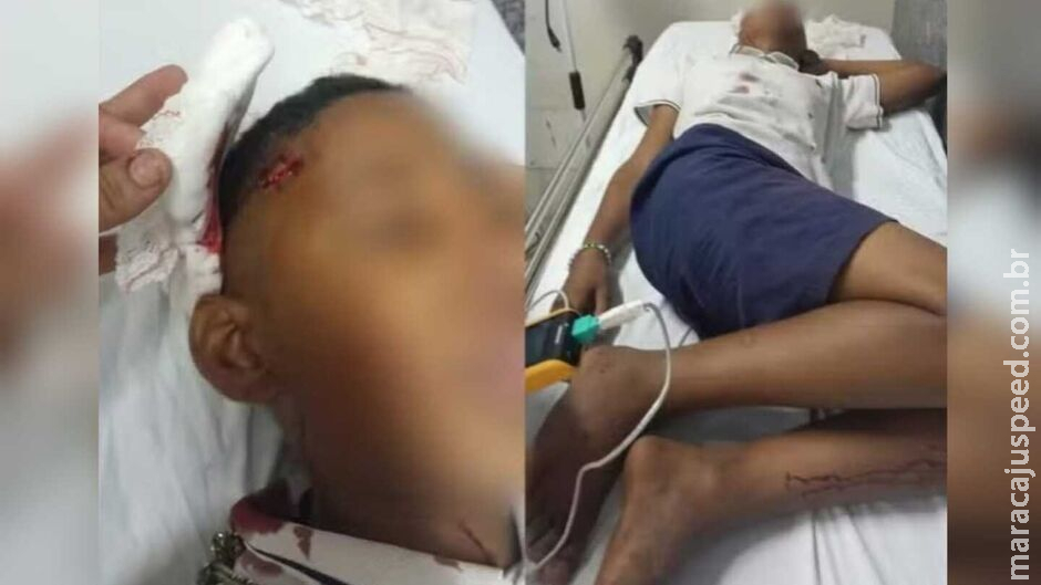 Criança tem crânio rachado após ser agredido com paulada em escola de MT Criança tem crânio rachado após ser agredido com paulada em escola de MT