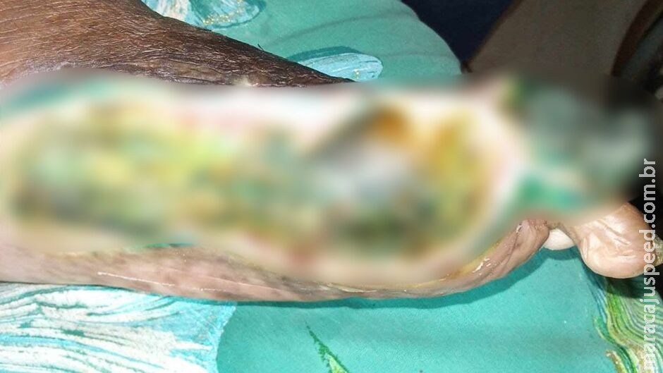 Idosa com pé necrosado aguarda vaga para amputação urgente há 7 dias em Nova Alvorada do Sul Idosa com pé necrosado aguarda vaga para amputação urgente há 7 dias em Nova Alvorada do Sul