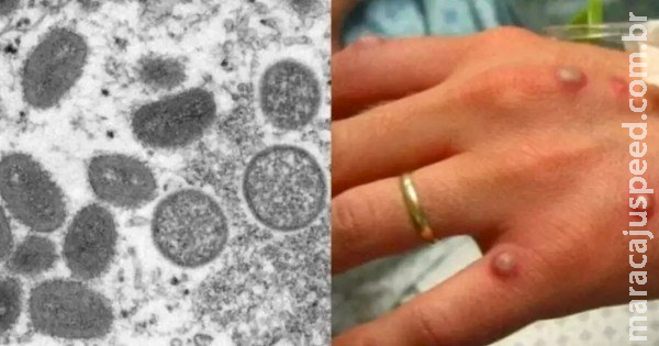 Corumbá: Secretaria de Saúde confirma caso de Mpox em homem de 27 anos Corumbá: Secretaria de Saúde confirma caso de Mpox em homem de 27 anos