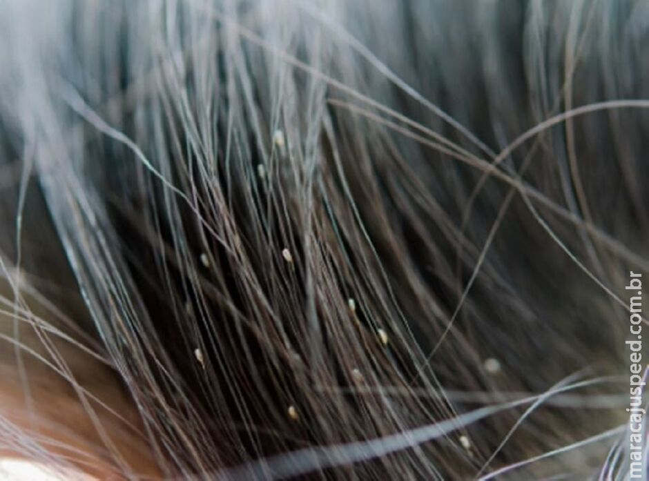Mulher tem cabelo infestado de piolhos após colocar mega-hair em salão Mulher tem cabelo infestado de piolhos após colocar mega-hair em salão