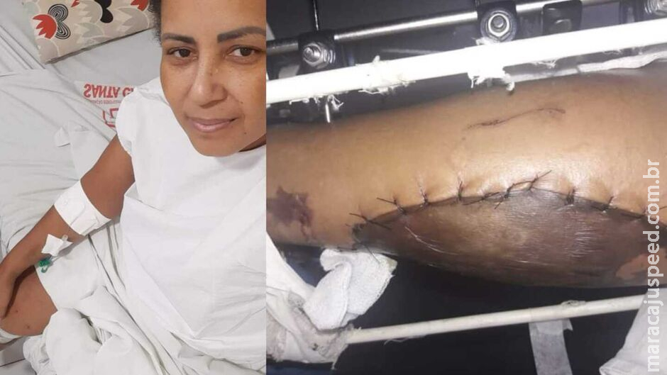 Sem prótese adequada para sua idade, paciente aguarda cirurgia no quadril pela Santa Casa Sem prótese adequada para sua idade, paciente aguarda cirurgia no quadril pela Santa Casa