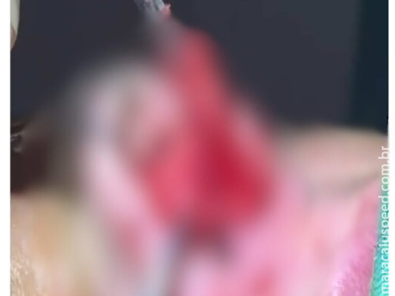 Dentista faz rinoplastia, provoca necrose em cliente e acaba procurada pela polícia em Campo Grande Dentista faz rinoplastia, provoca necrose em cliente e acaba procurada pela polícia em Campo Grande