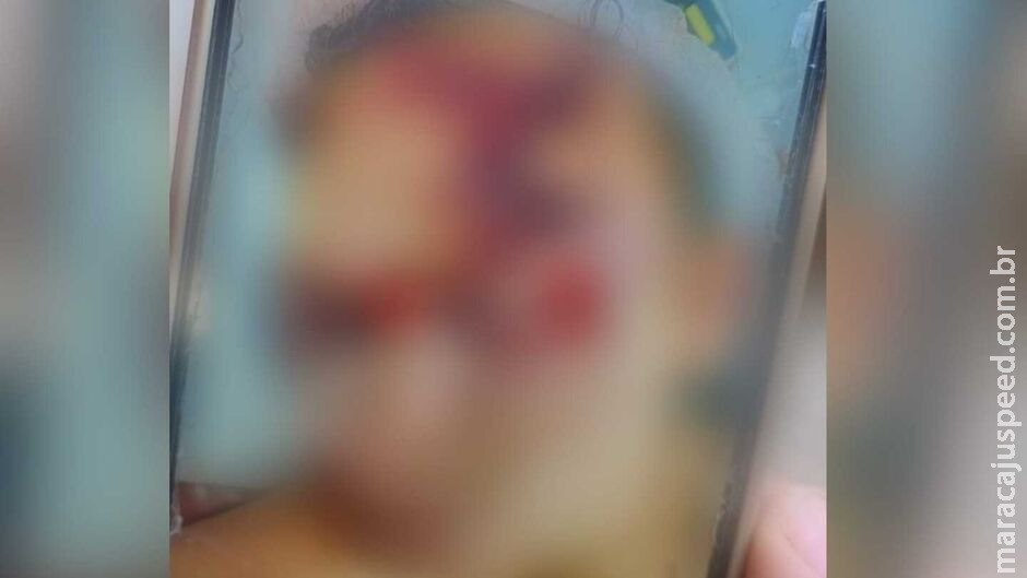 Jovem é espancado em confraternização e fica com rosto desfigurado em Sidrolândia Jovem é espancado em confraternização e fica com rosto desfigurado em Sidrolândia