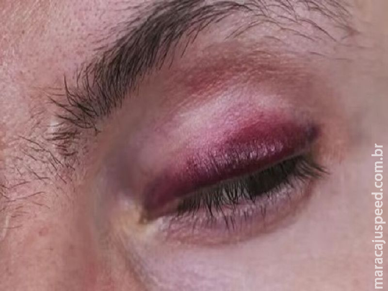 Homem é agredido pelo próprio irmão por ciúmes da mãe no Amambaí Homem é agredido pelo próprio irmão por ciúmes da mãe no Amambaí