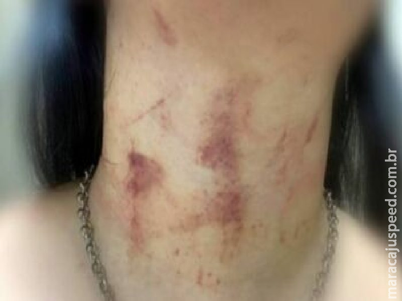 Policial é agredida e enforcada por namorado durante briga em condomínio Policial é agredida e enforcada por namorado durante briga em condomínio