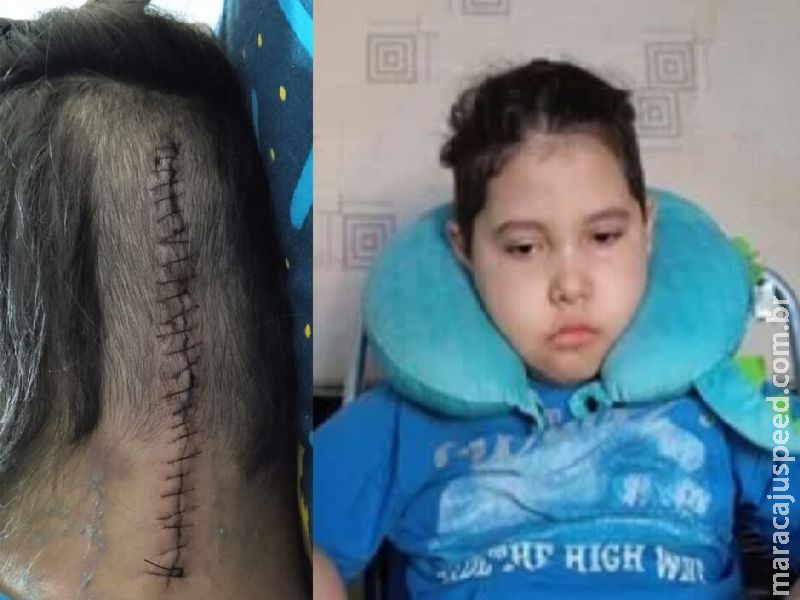 Moisés removeu tumor no cérebro e desafio agora é voltar a andar, falar e comer Moisés removeu tumor no cérebro e desafio agora é voltar a andar, falar e comer