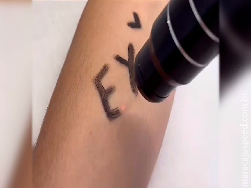 Remoção de tatuagens: após Dia dos Namorados, alguns preferem apagar o passado - da pele Remoção de tatuagens: após Dia dos Namorados, alguns preferem apagar o passado - da pele