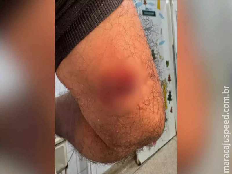 Servidor da saúde é mordido por paciente da UPA que aguardava vaga na psiquiatria da UFGD Servidor da saúde é mordido por paciente da UPA que aguardava vaga na psiquiatria da UFGD
