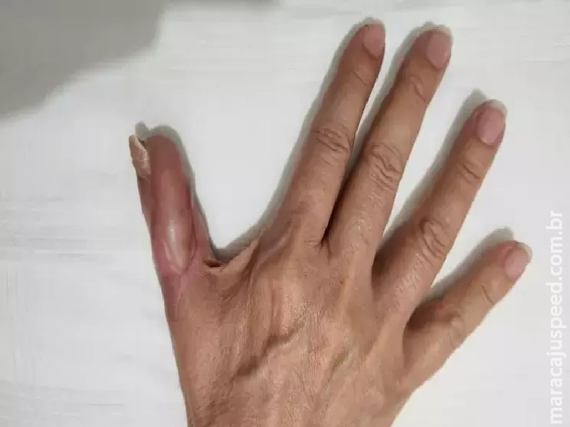 Mulher passa por quatro cirurgias no dedo após fazer as unhas em salão de beleza Mulher passa por quatro cirurgias no dedo após fazer as unhas em salão de beleza