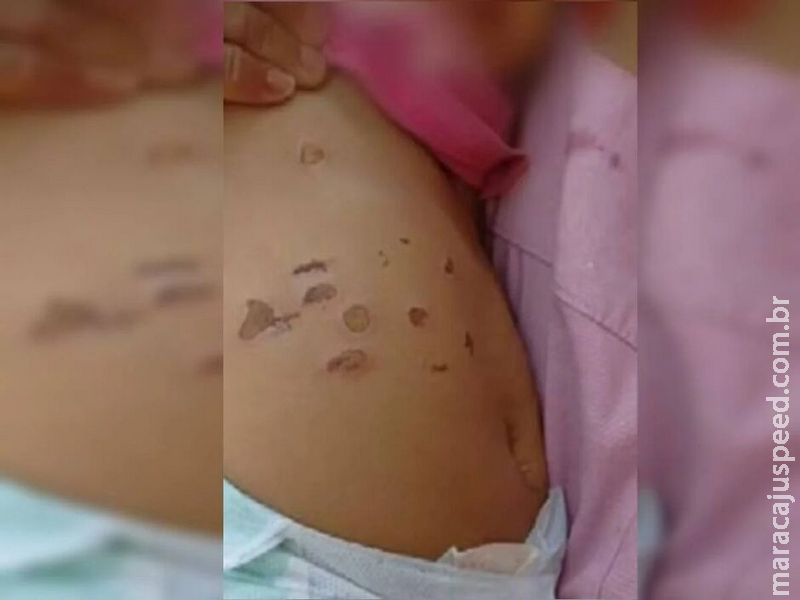 Menina de 10 meses foi queimada com cigarros na barriga e nas pernas Menina de 10 meses foi queimada com cigarros na barriga e nas pernas