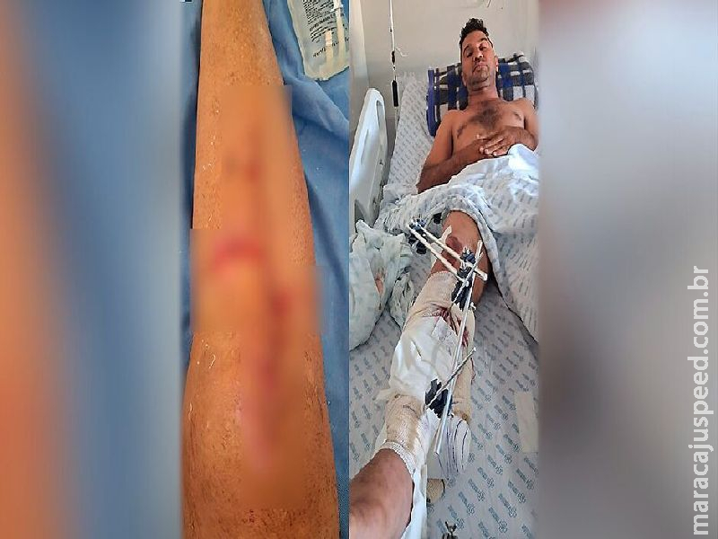 Motociclista tem perna estourada em acidente em Campo Grande: 