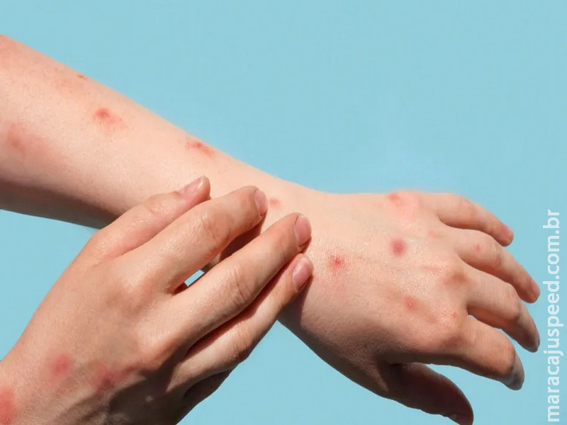 Brasil chega a 140 casos confirmados de mpox em 2026