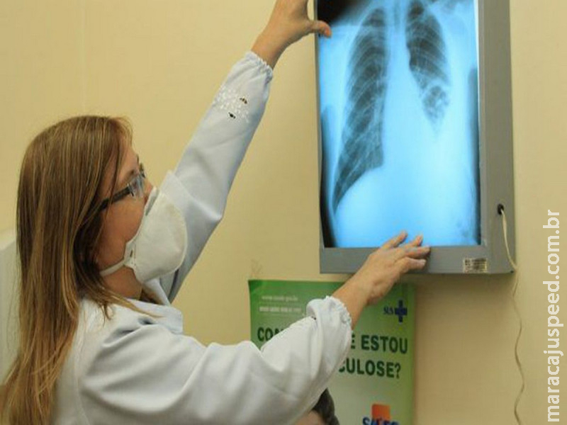 Diante do aumento de casos de tuberculose, prefeitura capacita equipes de saúde