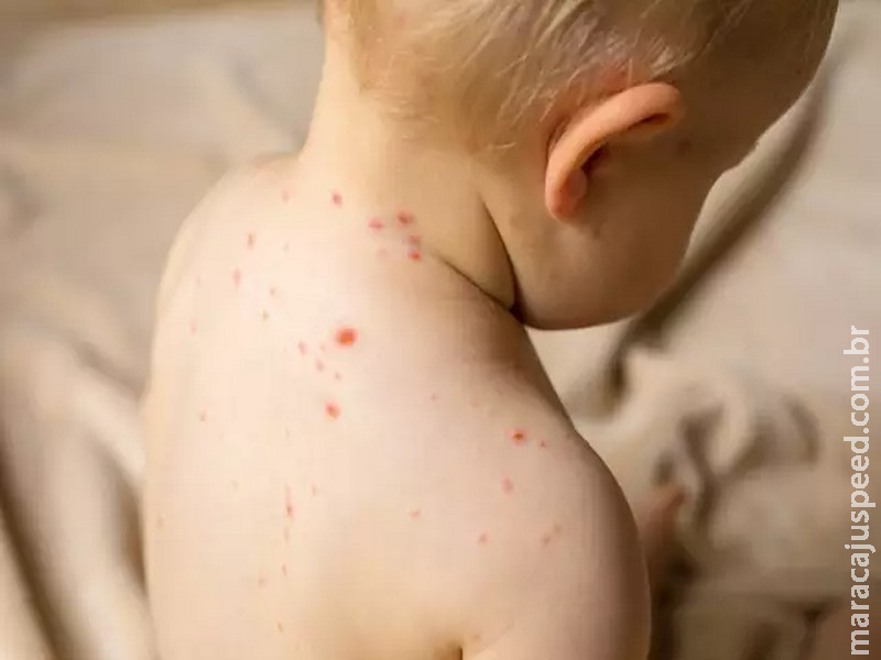 Sarampo: 10 sinais que pedem atenção em crianças e gestantes